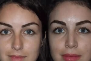 rhinoplasty in Dubai
