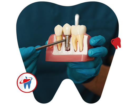 teeth implant Perth, teeth implants, teeth implant in Perth