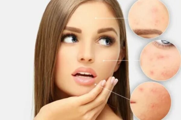 Dermal fillers in Chandigarh