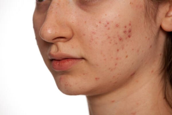 Can Acne Treatment improve facial appearance