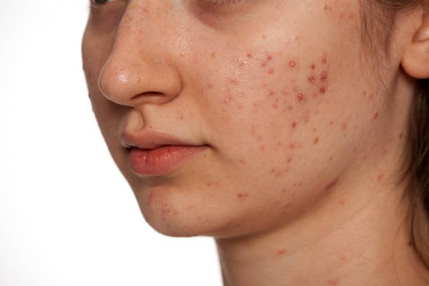 Can Acne Treatment improve facial appearance