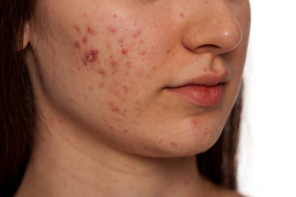 Can Laser Acne Scar Treatment Reduce Pitted Scars