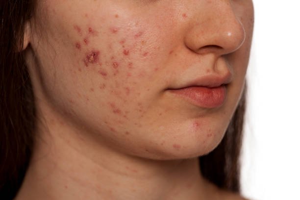 Can Laser Acne Scar Treatment Reduce Pitted Scars