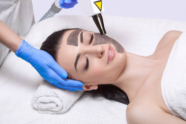 Can Laser Carbon Peel Revive Lackluster Skin Quickly