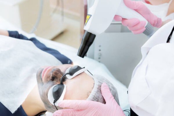 Can Laser Carbon Peel help fade mild acne marks