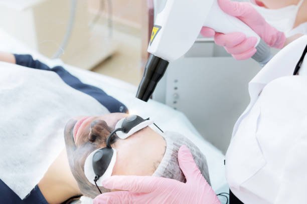 Can Laser Carbon Peel help fade mild acne marks