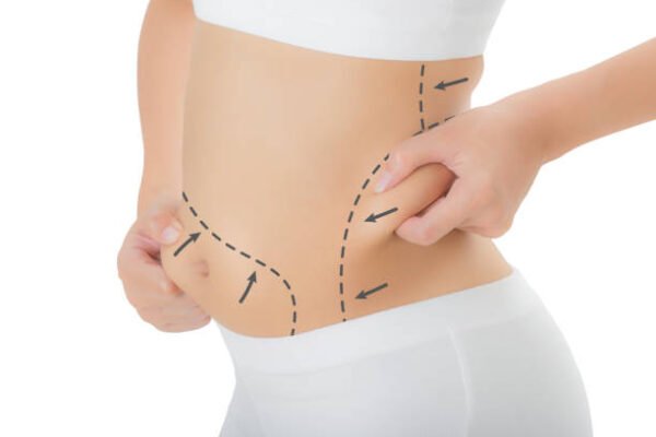 Can Laser Liposuction reduce stubborn back fat