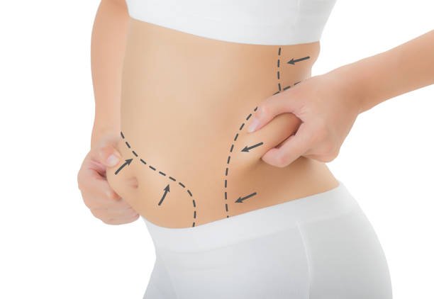 Can Laser Liposuction reduce stubborn back fat