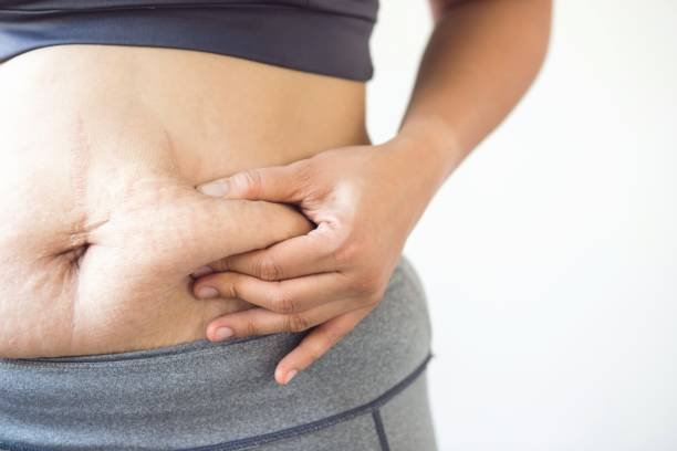 Can Mini Abdominoplasty improve waist definition
