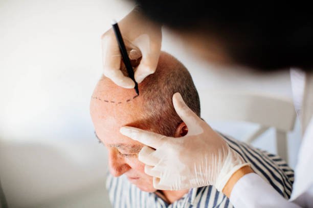 Can Scalp Micropigmentation Work on Light Skin Tones