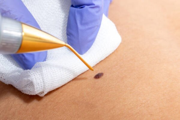 Can Skin Tag Removal Improve Your Skin Appearance