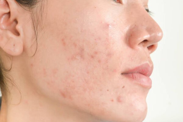 Does Acne Treatment Help With Acne Inflammation