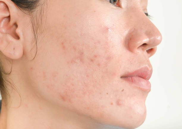 Does Acne Treatment Help With Acne Inflammation