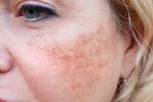 Dermal Pigmentation in Abu Dhabi