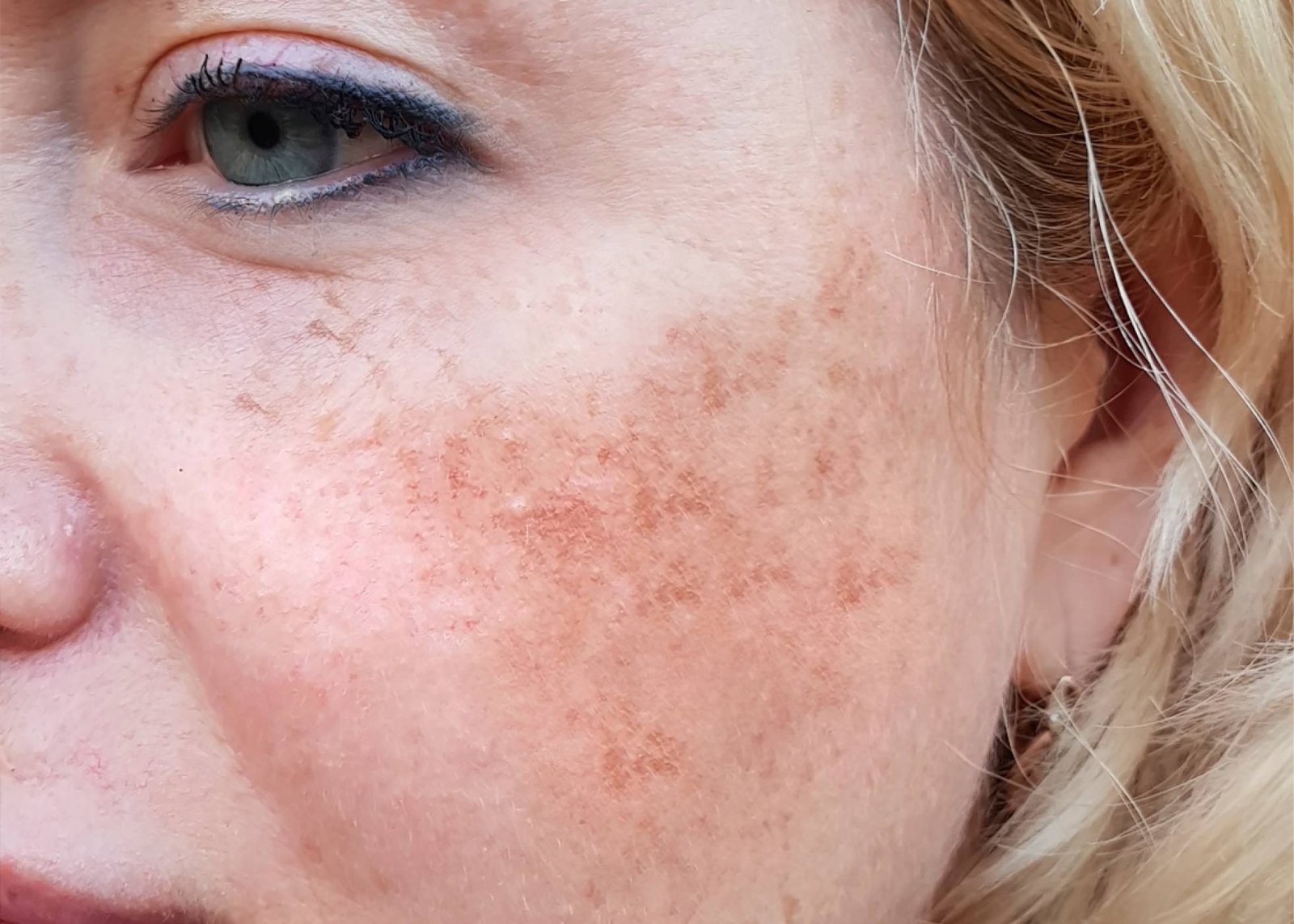 Dermal Pigmentation in Abu Dhabi