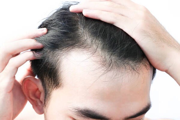 Does Hair Transplant Look Natural After Healing
