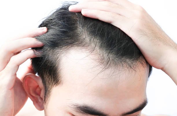 Does Hair Transplant Look Natural After Healing