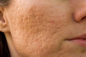 Large Pores Treatment in Abu Dhabi