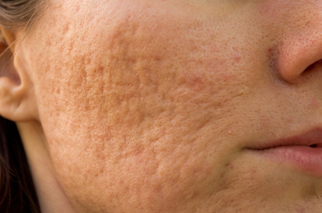 Large Pores Treatment in Abu Dhabi
