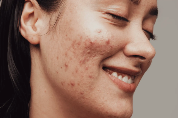 Laser Acne Scar treatment Abu Dhabi