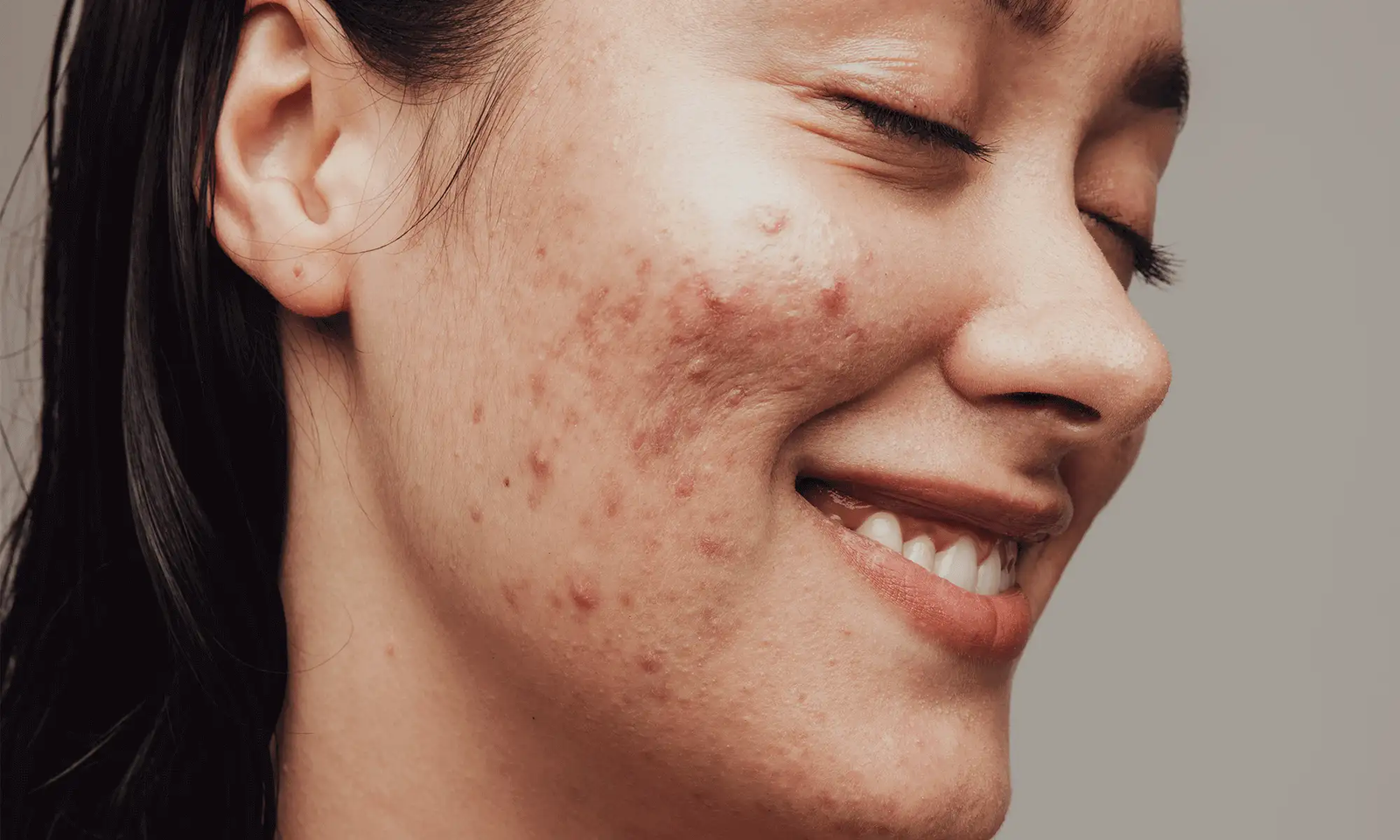 Laser Acne Scar treatment Abu Dhabi