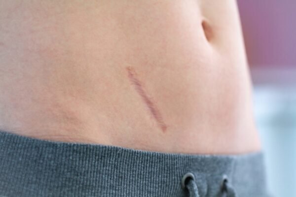 Keloid Treatment Abu Dhabi