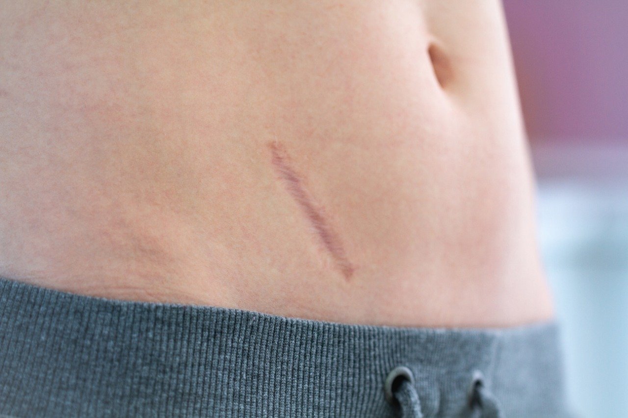 Keloid Treatment Abu Dhabi