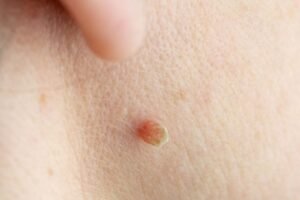 Skin Tag Removal in Abu Dhabi