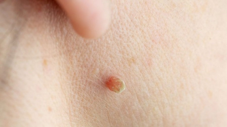 Skin Tag Removal in Abu Dhabi
