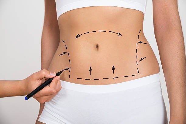 How Does Mini Tummy Tuck Reshape the Lower Belly