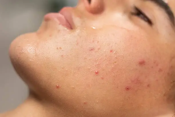How Long Does Acne Treatment Take to Show Results