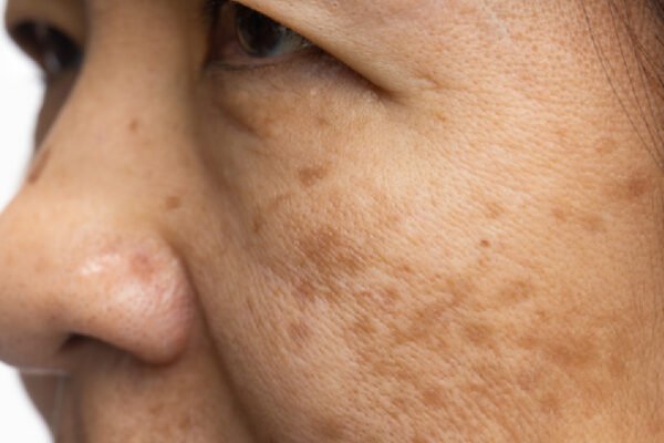 Pigmentation Treatment in Abu Dhabi