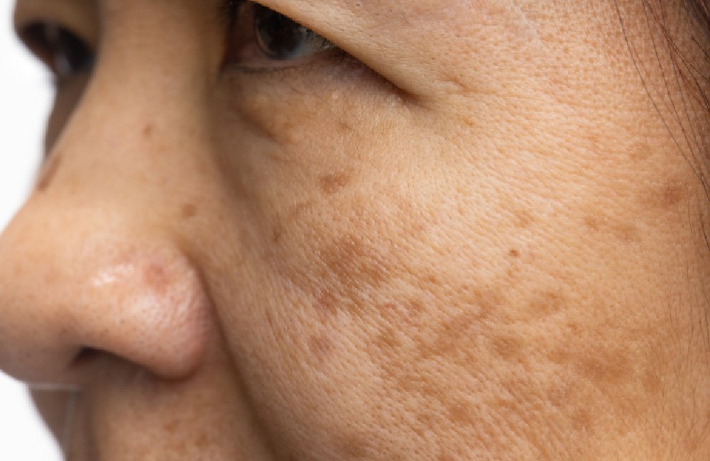 Pigmentation Treatment in Abu Dhabi