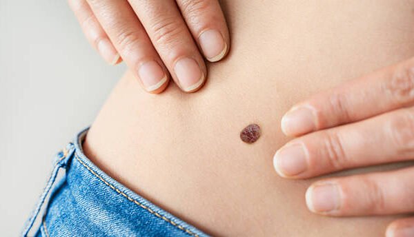 How Soon Can Warts Removal Treatment Restore Skin