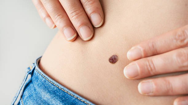 How Soon Can Warts Removal Treatment Restore Skin