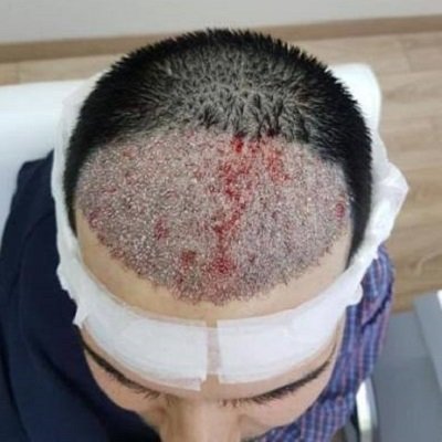 زراعة الشعر في دبي