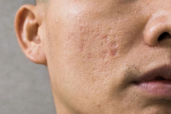 Acne Treatment in Abu Dhabi