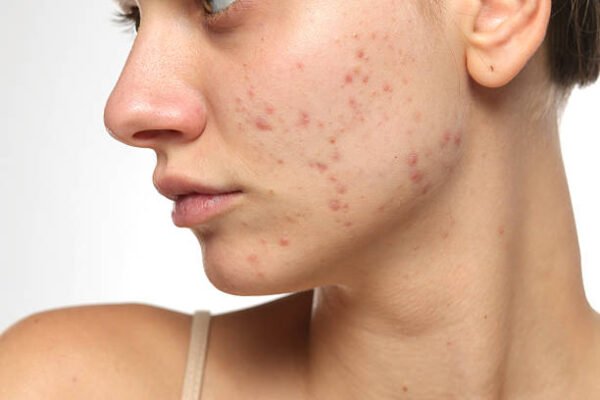 Is Acne Treatment suitable for all skin types