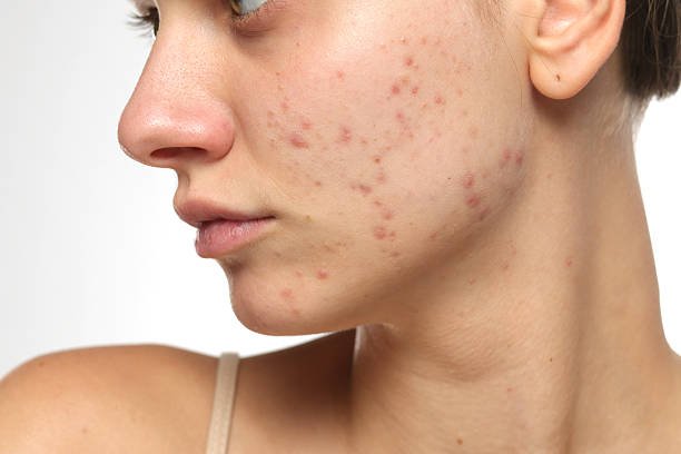 Is Acne Treatment suitable for all skin types