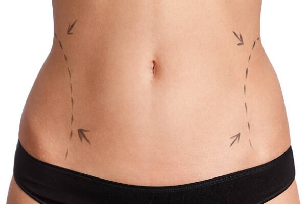Is Body Lift right for stubborn excess body skin