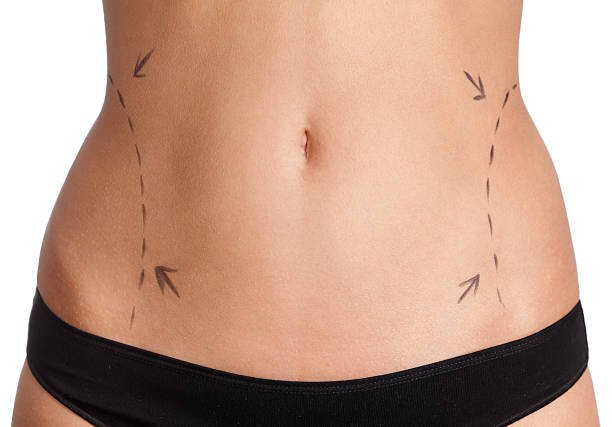 Is Body Lift right for stubborn excess body skin