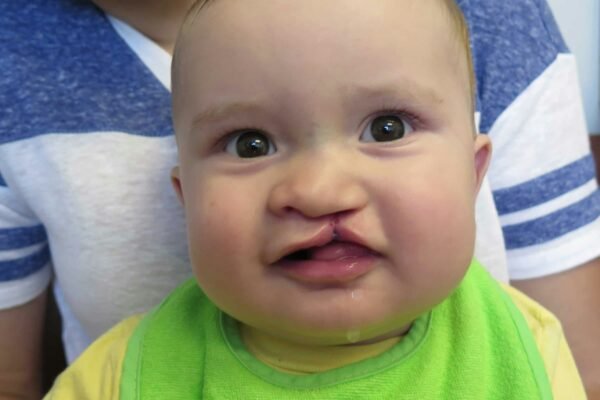 Cleft Lip and Palate Surgery in Abu Dhabi