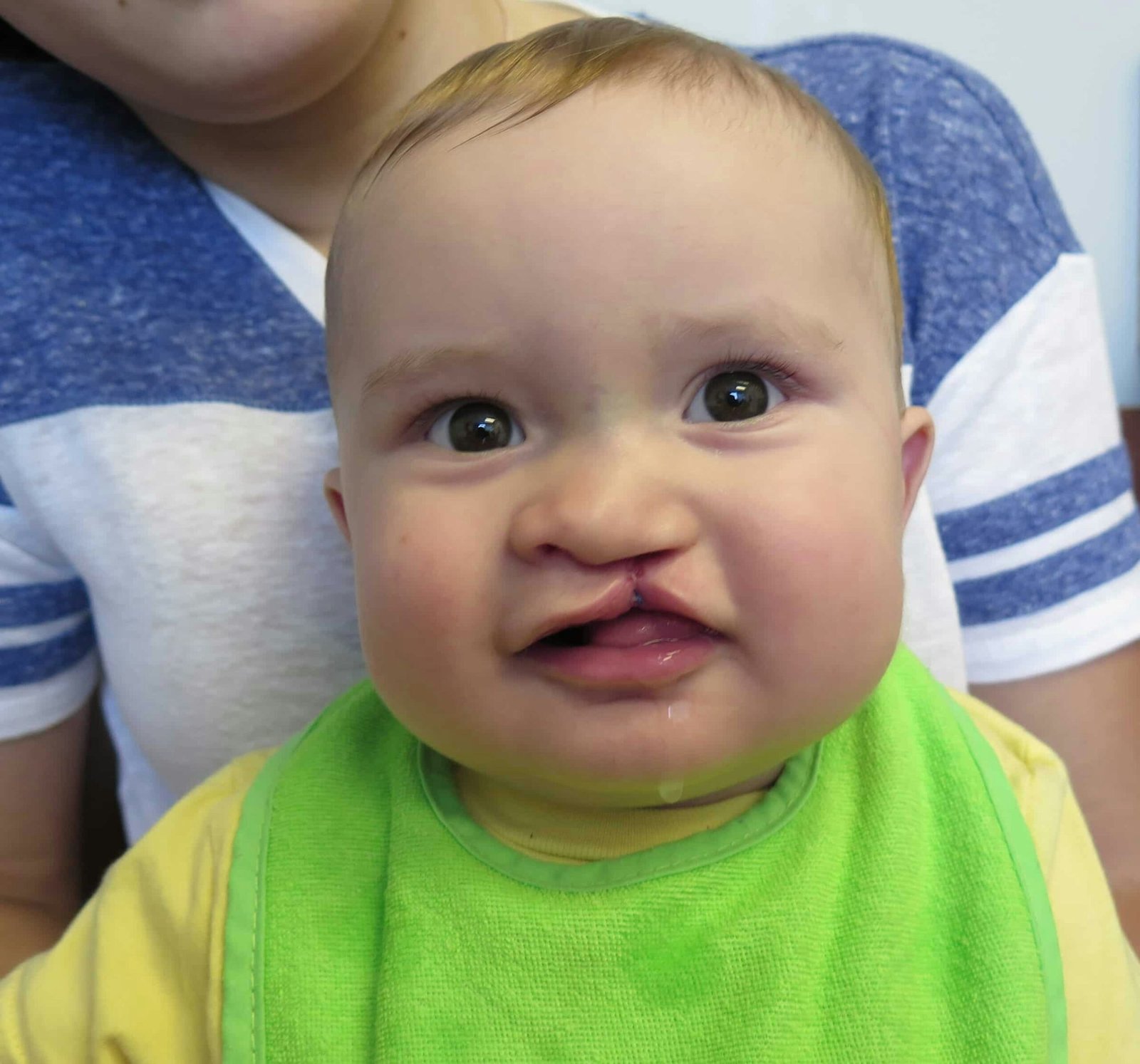 Cleft Lip and Palate Surgery in Abu Dhabi