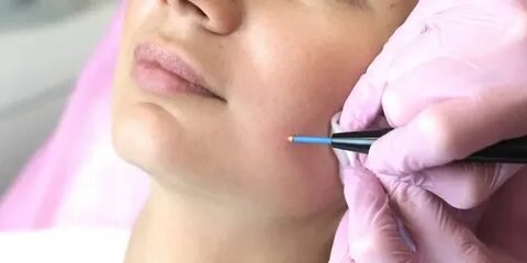 Is Electrolysis safe for long-term hair removal plans