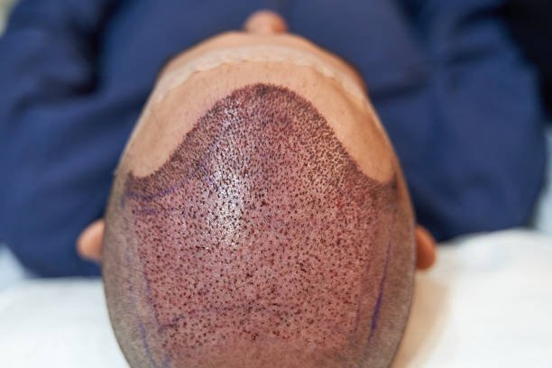 Is Enfield Royal Clinic suitable for hair transplants