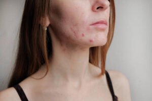 Is Laser Acne Scar Treatment Good for Stubborn Scars