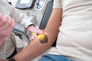 Is Laser Tattoo Removal Suitable for Small Tattoos