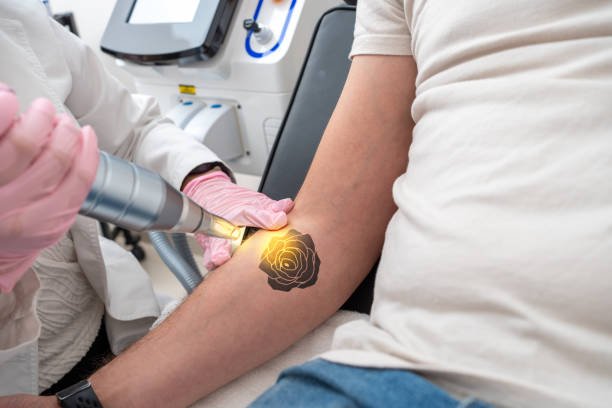 Is Laser Tattoo Removal Suitable for Small Tattoos