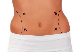 Is Lipo Abdominoplasty suitable after childbirth