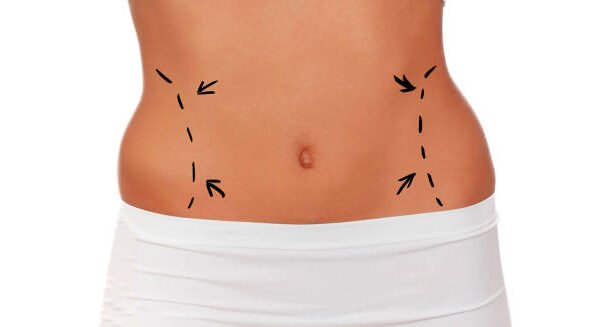 Is Lipo Abdominoplasty suitable after childbirth